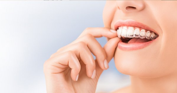 Vorteile von unsichtbaren Zahnspangen für Erwachsene