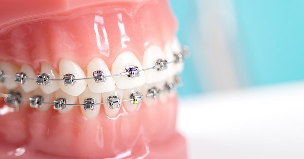 Die Entwicklung von Zahnspangen: Von traditionellen Brackets zu durchsichtigen Alignern